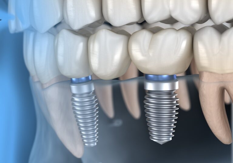 Melhor Clínica Para Implantes Dentários em mogi das cruzes
